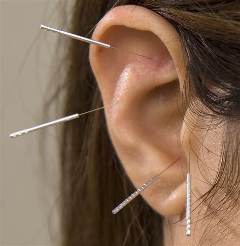 auricular acupuncture.